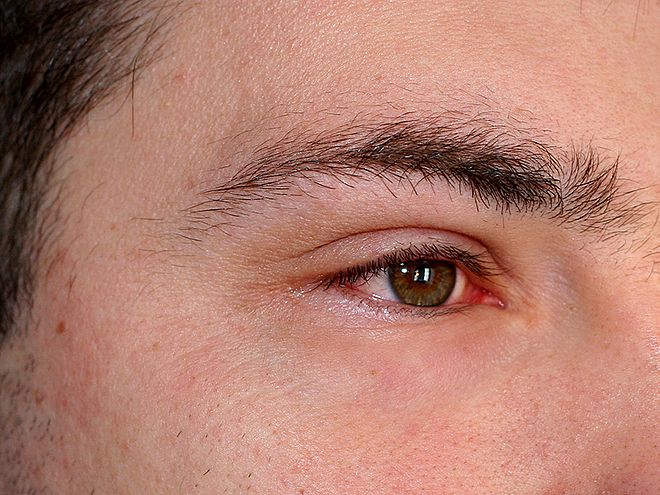 Auge Tut Weh Beim Schließen Augenentzündung: Symptome, Ursache und Behandlung